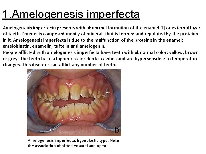 1. Amelogenesis imperfecta presents with abnormal formation of the enamel[1] or external layer of