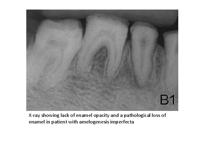 X-ray showing lack of enamel opacity and a pathological loss of enamel in patient
