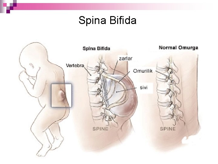 Spina Bifida 12 
