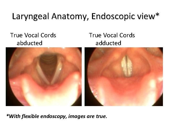 Laryngeal Anatomy, Endoscopic view* True Vocal Cords abducted True Vocal Cords adducted *With flexible