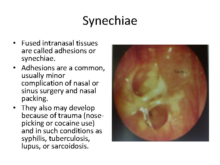 Synechiae • Fused intranasal tissues are called adhesions or synechiae. • Adhesions are a