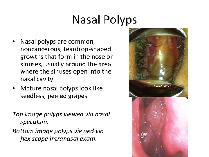 Nasal Polyps • Nasal polyps are common, noncancerous, teardrop-shaped growths that form in the