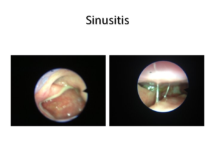 Sinusitis Mercado 2013 © 