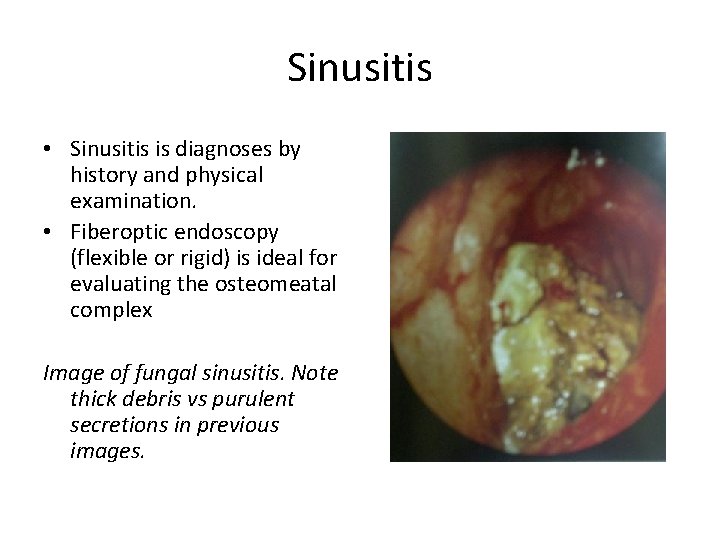Sinusitis • Sinusitis is diagnoses by history and physical examination. • Fiberoptic endoscopy (flexible