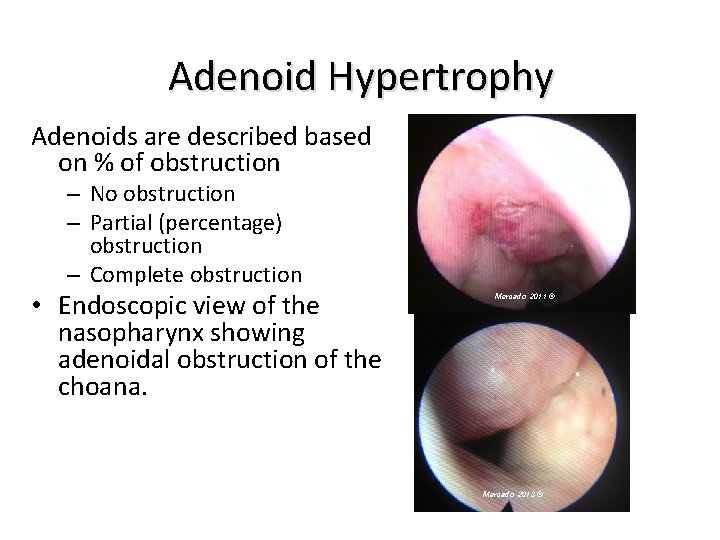 Adenoid Hypertrophy Adenoids are described based on % of obstruction – No obstruction –