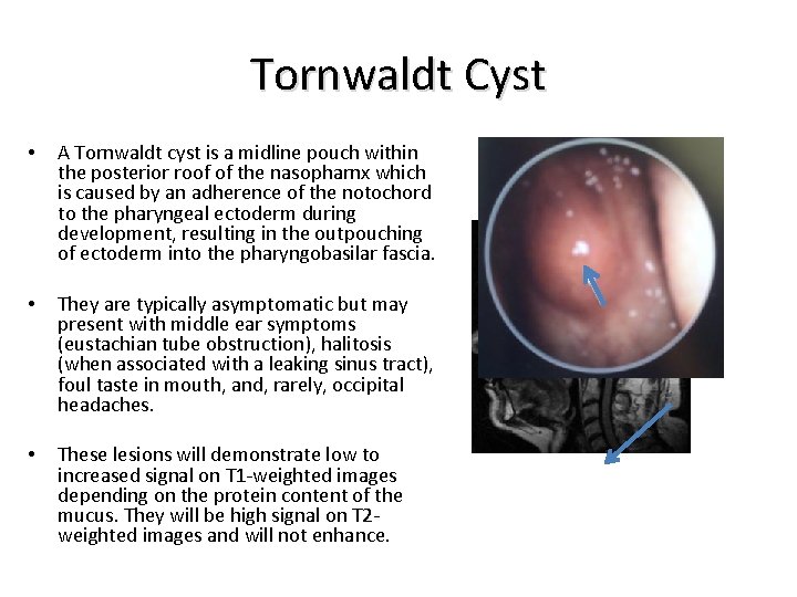 Tornwaldt Cyst • A Tornwaldt cyst is a midline pouch within the posterior roof