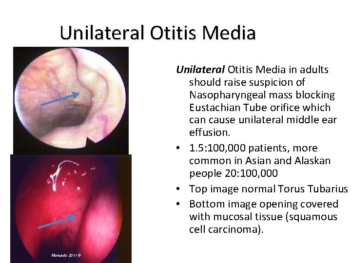 Unilateral Otitis Media Mercado 2011 © Unilateral Otitis Media in adults should raise suspicion