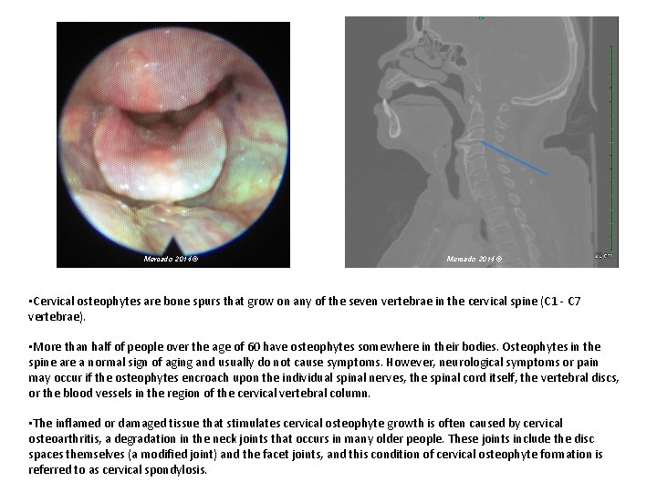 Mercado 2014 © • Cervical osteophytes are bone spurs that grow on any of