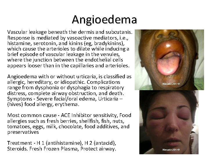 Angioedema Vascular leakage beneath the dermis and subcutanis. Response is mediated by vasoactive mediators,