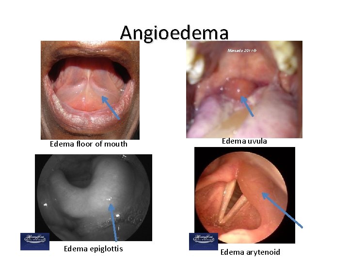 Angioedema Mercado 2011 © Edema floor of mouth Edema epiglottis Edema uvula Edema arytenoid