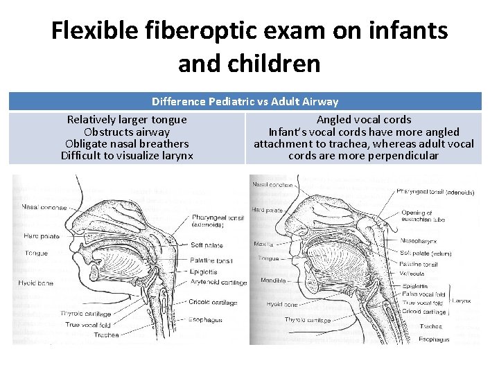 Flexible fiberoptic exam on infants and children Difference Pediatric vs Adult Airway Relatively larger
