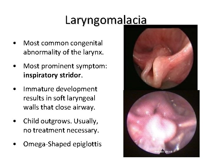 Laryngomalacia • Most common congenital abnormality of the larynx. • Most prominent symptom: inspiratory