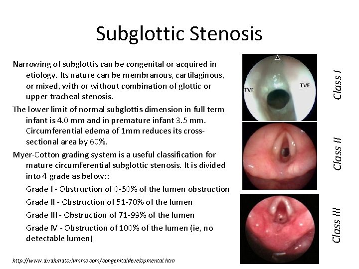 http: //www. drrahmatorlummc. com/congenitaldevelopmental. htm Class III Narrowing of subglottis can be congenital or