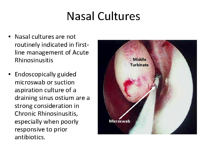 Nasal Cultures • Nasal cultures are not routinely indicated in firstline management of Acute