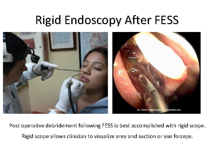 Rigid Endoscopy After FESS Mercado 2011 © Dr. Kevin Kavanaugh © www. entusa. com