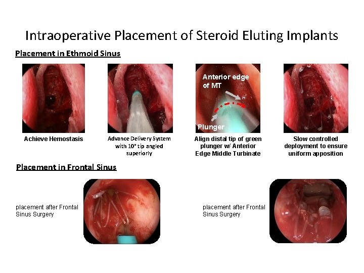 Intraoperative Placement of Steroid Eluting Implants Placement in Ethmoid Sinus Anterior edge of MT