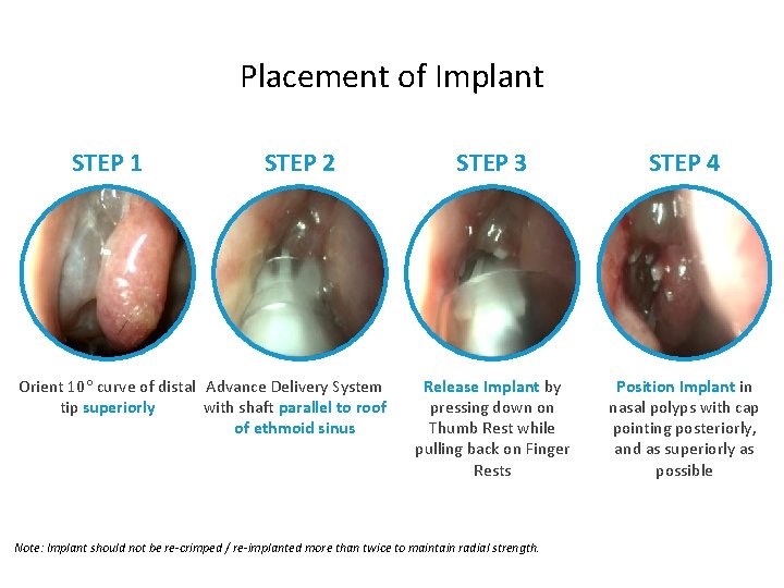 Placement of Implant STEP 1 STEP 2 Orient 10 curve of distal Advance Delivery
