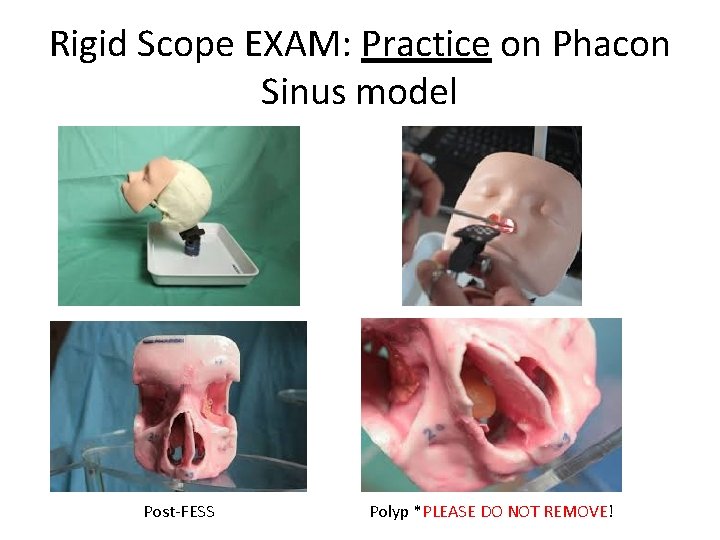 Rigid Scope EXAM: Practice on Phacon Sinus model Post-FESS Polyp *PLEASE DO NOT REMOVE!