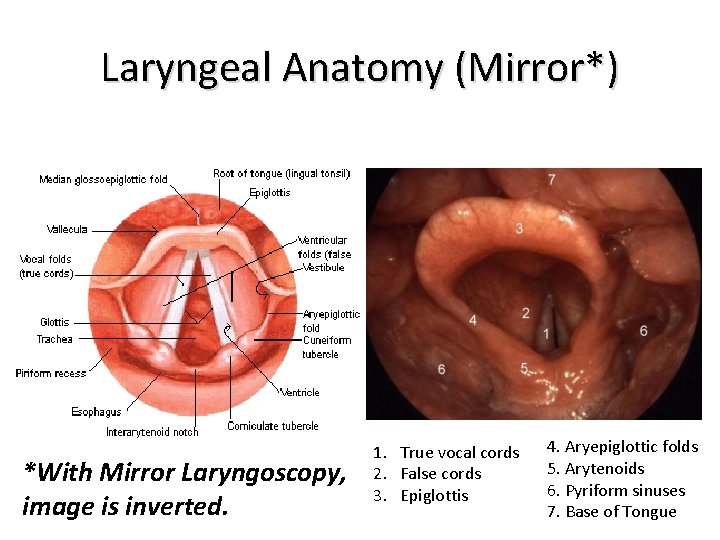 Laryngeal Anatomy (Mirror*) *With Mirror Laryngoscopy, image is inverted. 1. True vocal cords 2.
