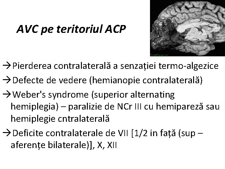 AVC pe teritoriul ACP Pierderea contralaterală a senzației termo-algezice Defecte de vedere (hemianopie contralaterală)