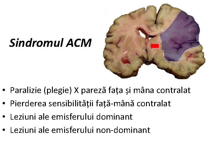 Sindromul ACM • • Paralizie (plegie) X pareză fața și mâna contralat Pierderea sensibilității