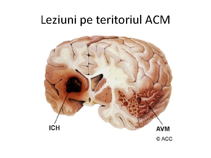 Leziuni pe teritoriul ACM 