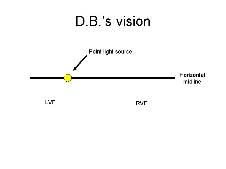 D. B. ’s vision Point light source Horizontal midline LVF RVF 
