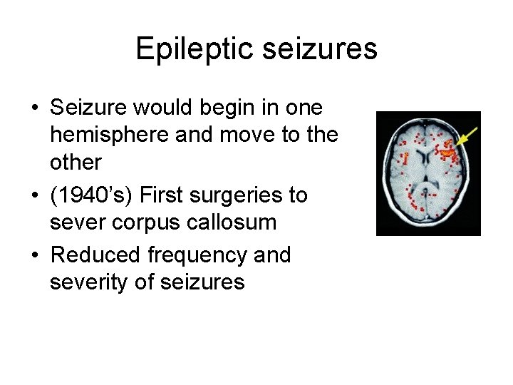 Epileptic seizures • Seizure would begin in one hemisphere and move to the other