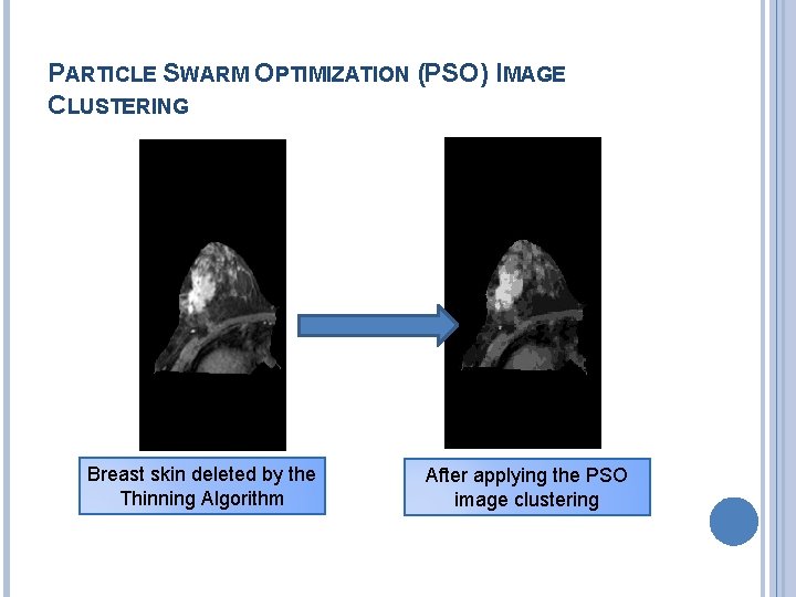 PARTICLE SWARM OPTIMIZATION (PSO) IMAGE CLUSTERING Breast skin deleted by the Thinning Algorithm After