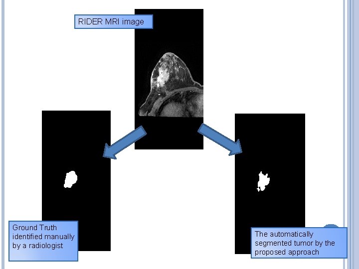 RIDER MRI image Ground Truth identified manually by a radiologist The automatically segmented tumor