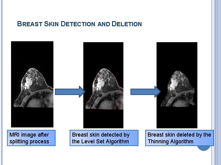 BREAST SKIN DETECTION AND DELETION MRI image after splitting process Breast skin detected by