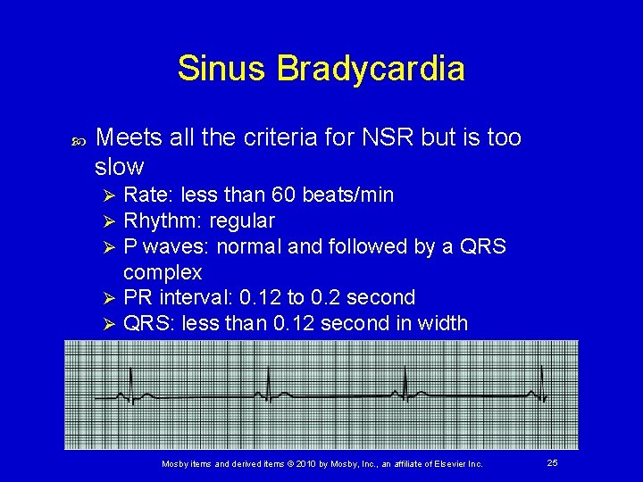 Sinus Bradycardia Meets all the criteria for NSR but is too slow Rate: less