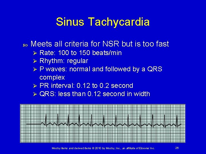 Sinus Tachycardia Meets all criteria for NSR but is too fast Rate: 100 to