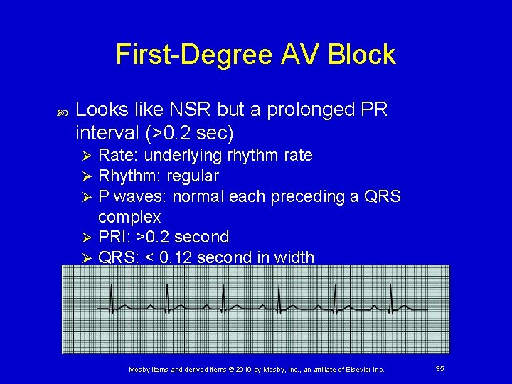 First-Degree AV Block Looks like NSR but a prolonged PR interval (>0. 2 sec)