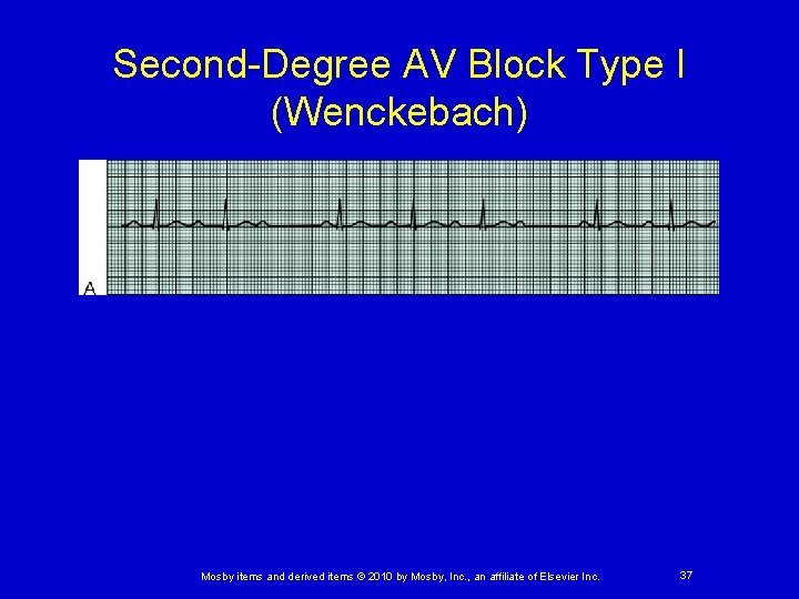 Second-Degree AV Block Type I (Wenckebach) Mosby items and derived items © 2010 by