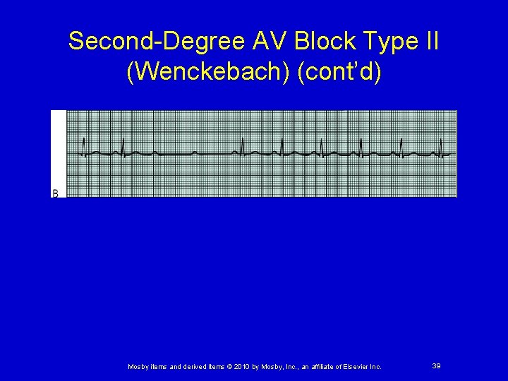 Second-Degree AV Block Type II (Wenckebach) (cont’d) Mosby items and derived items © 2010