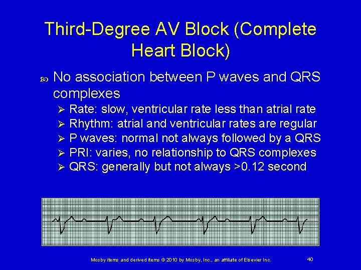 Third-Degree AV Block (Complete Heart Block) No association between P waves and QRS complexes