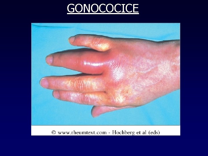 GONOCOCICE 