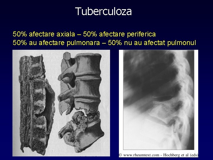 Tuberculoza 50% afectare axiala – 50% afectare periferica 50% au afectare pulmonara – 50%