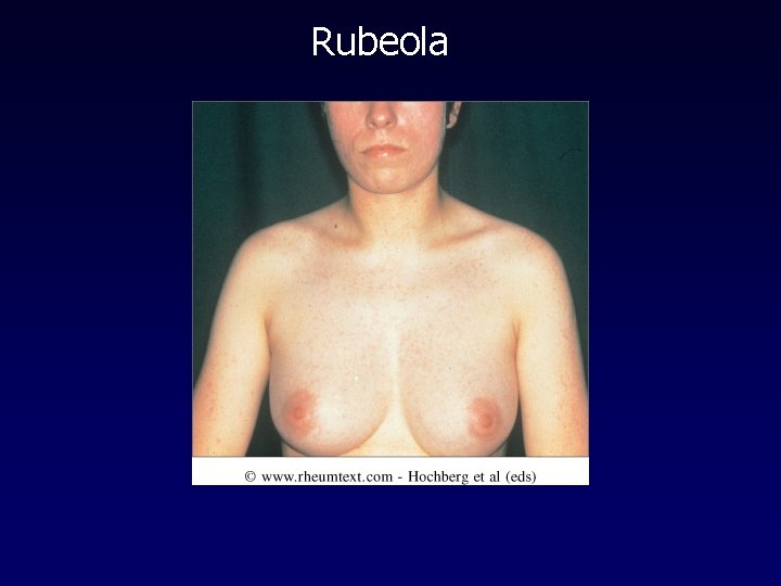 Rubeola 