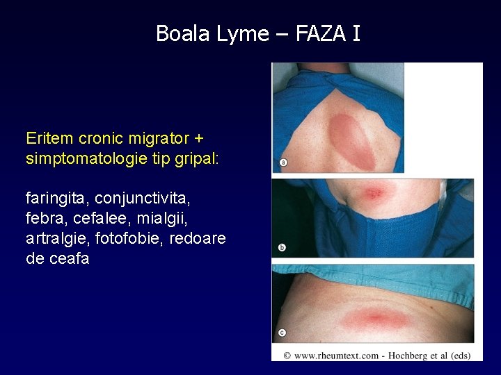 Boala Lyme – FAZA I Eritem cronic migrator + simptomatologie tip gripal: faringita, conjunctivita,