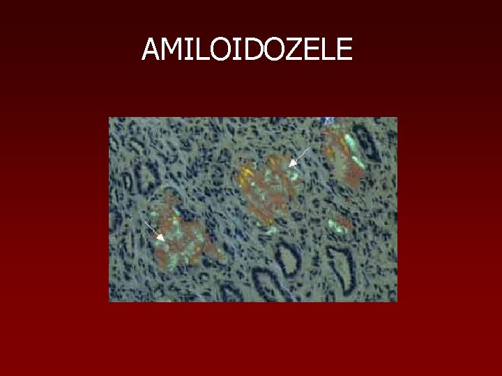 AMILOIDOZELE 