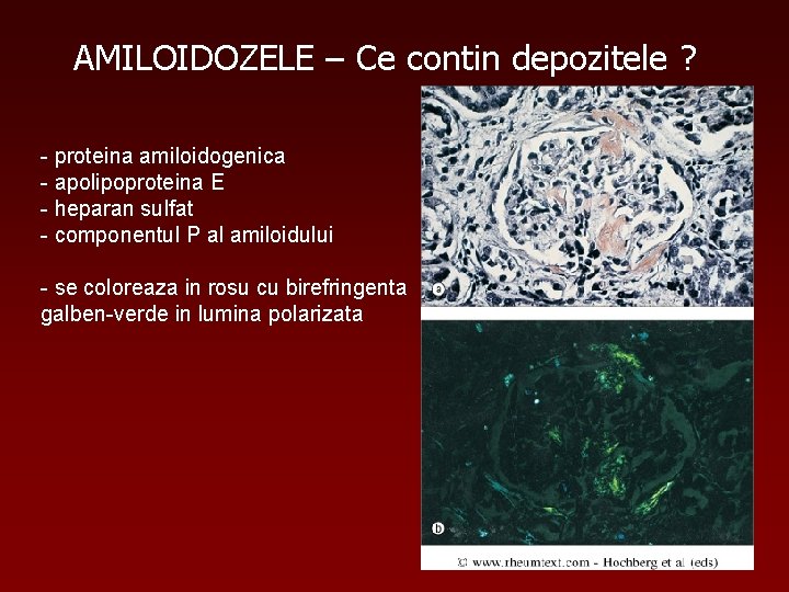 AMILOIDOZELE – Ce contin depozitele ? - proteina amiloidogenica - apolipoproteina E - heparan