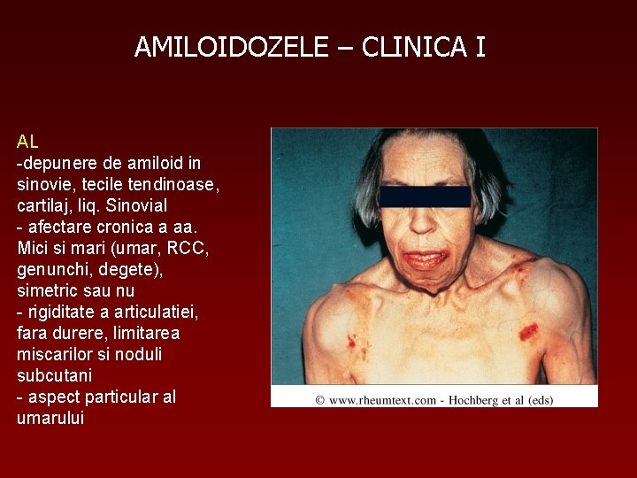 AMILOIDOZELE – CLINICA I AL -depunere de amiloid in sinovie, tecile tendinoase, cartilaj, liq.