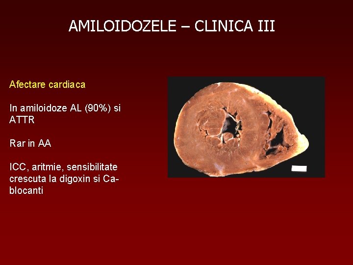 AMILOIDOZELE – CLINICA III Afectare cardiaca In amiloidoze AL (90%) si ATTR Rar in