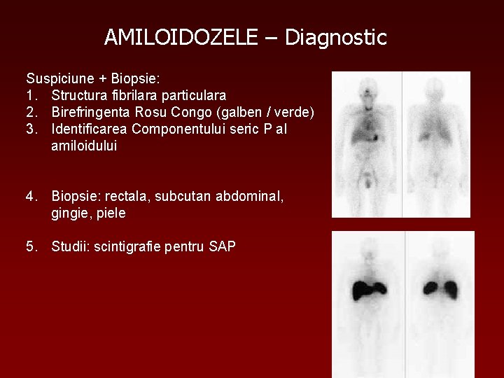 AMILOIDOZELE – Diagnostic Suspiciune + Biopsie: 1. Structura fibrilara particulara 2. Birefringenta Rosu Congo