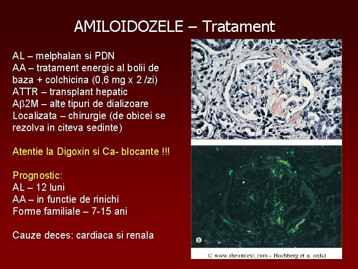 AMILOIDOZELE – Tratament AL – melphalan si PDN AA – tratament energic al bolii