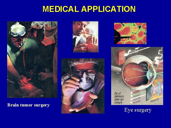 MEDICAL APPLICATION Brain tumor surgery Eye surgery 