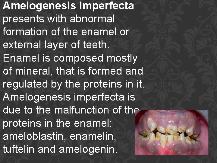 Amelogenesis imperfecta presents with abnormal formation of the enamel or external layer of teeth.