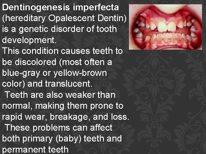 Dentinogenesis imperfecta (hereditary Opalescent Dentin) is a genetic disorder of tooth development. This condition